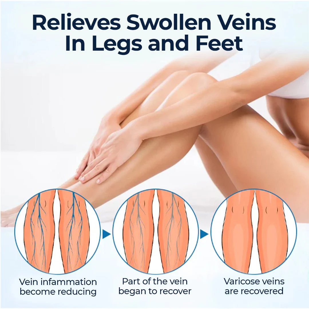 CVREOZ® Varicose Veins Spray