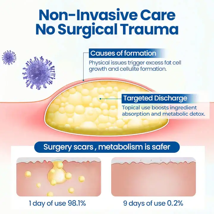 Cvreoz® Lipoma Removal Cream