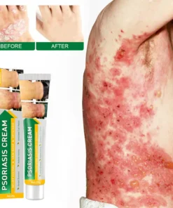 NESLEMY™ Psoriasis Cure Cream