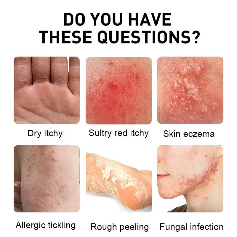 NESLEMY™ Psoriasis Cure Cream