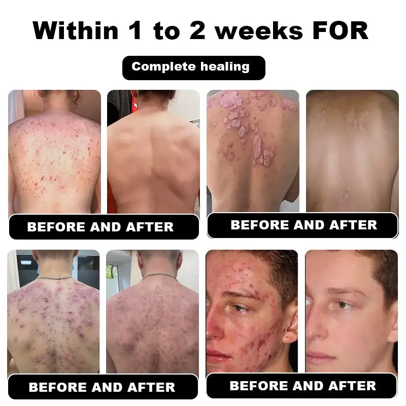 NESLEMY™ Psoriasis Cure Cream