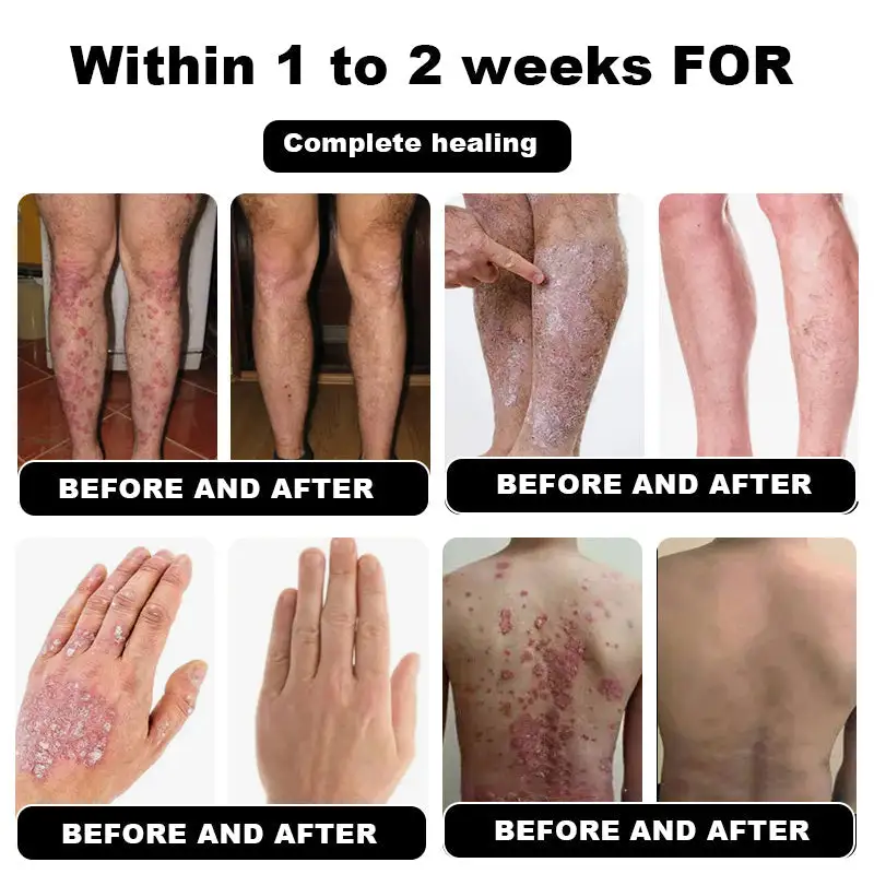 NESLEMY™ Psoriasis Cure Cream