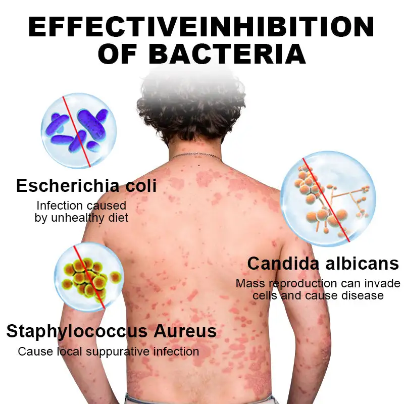 NESLEMY™ Psoriasis Cure Cream