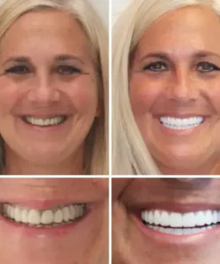 OFFICIAL STORE: Seurico™ – 🦷Advanced Customized Full Denture Set